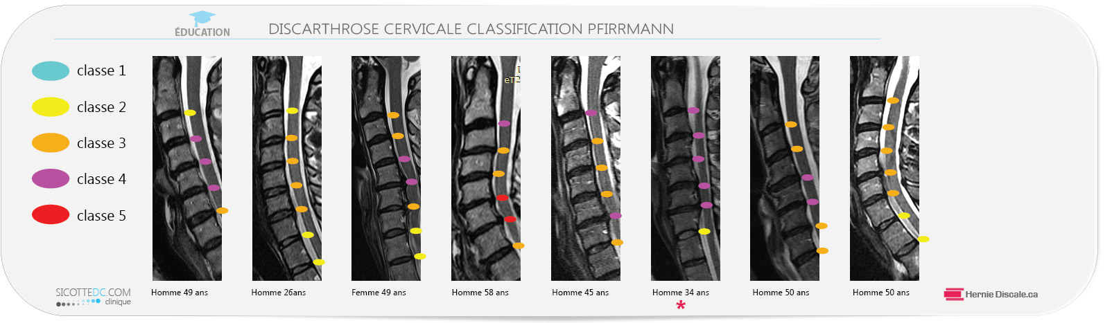 Exemples de discarthrose cervicale classification Pfirrmann pour hernie discale cervicale.