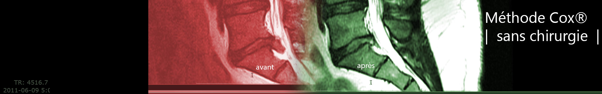 La méthode sans chirurgie Cox pour les traitement de hernie discale, sténose foraminale lombaire.