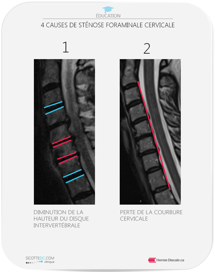 Quatre causes de la sténose foraminale 1 diminution de la hauteru du disque intervertébrale, 2 perte de la courbure cervicale.