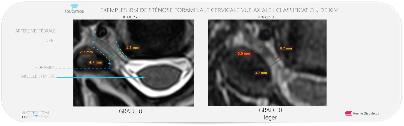 Exemple de sténose foraminale cervicale vue axiale IRM grade 0.