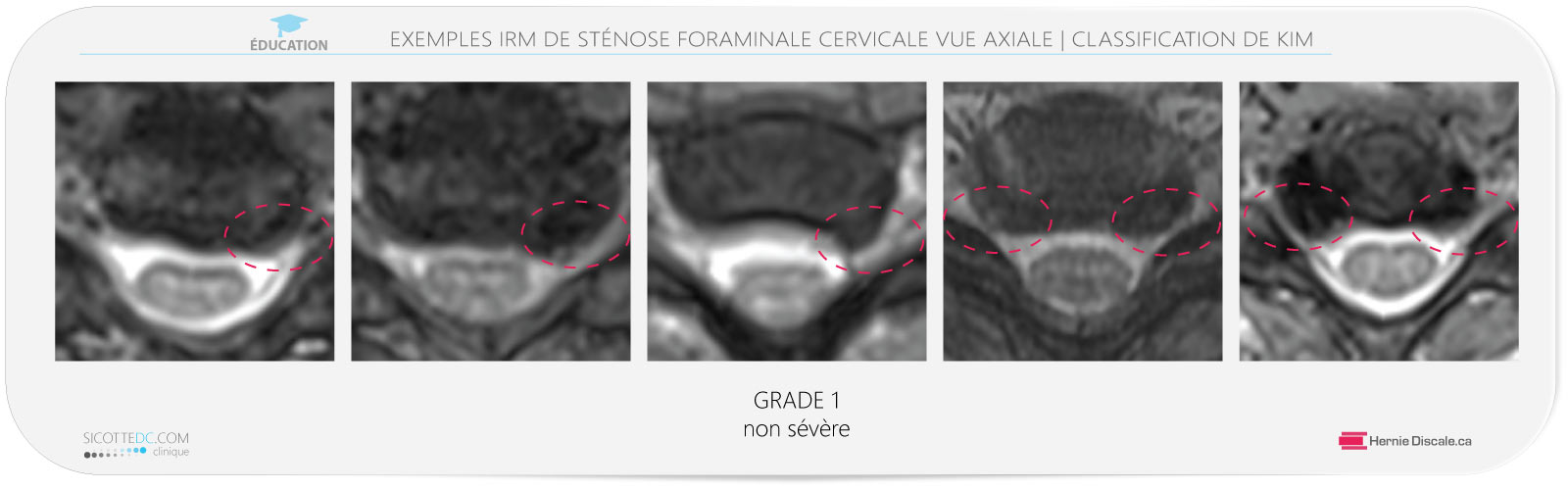 Sténose foraminale cervicale vue axiale IRM grade 1. Traitement avec la méthode Cox® en flexion distraction pour hernie discale C4-C5-C6-C7.
