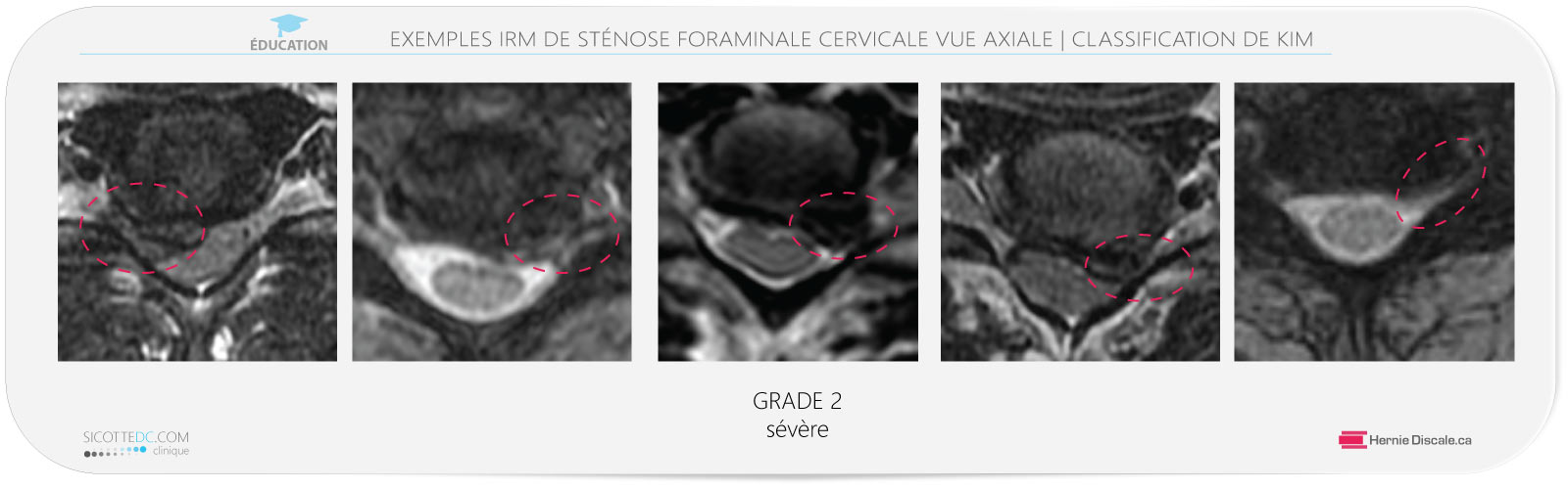 Sténose foraminale cervicale vue axiale IRM grade 2. Traitement avec la méthode Cox® en flexion distraction pour hernie discale C4-C5-C6-C7.