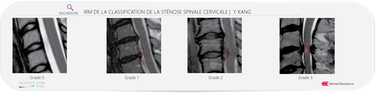 IMR cervicale de sténose spinale cervicale. Grade 0, 1, 2, 3