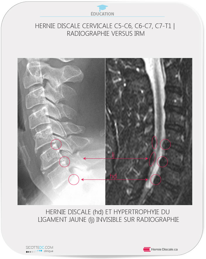 La comparaison de la hernie discale cervicale C-5C6-C7 et la radiographie.