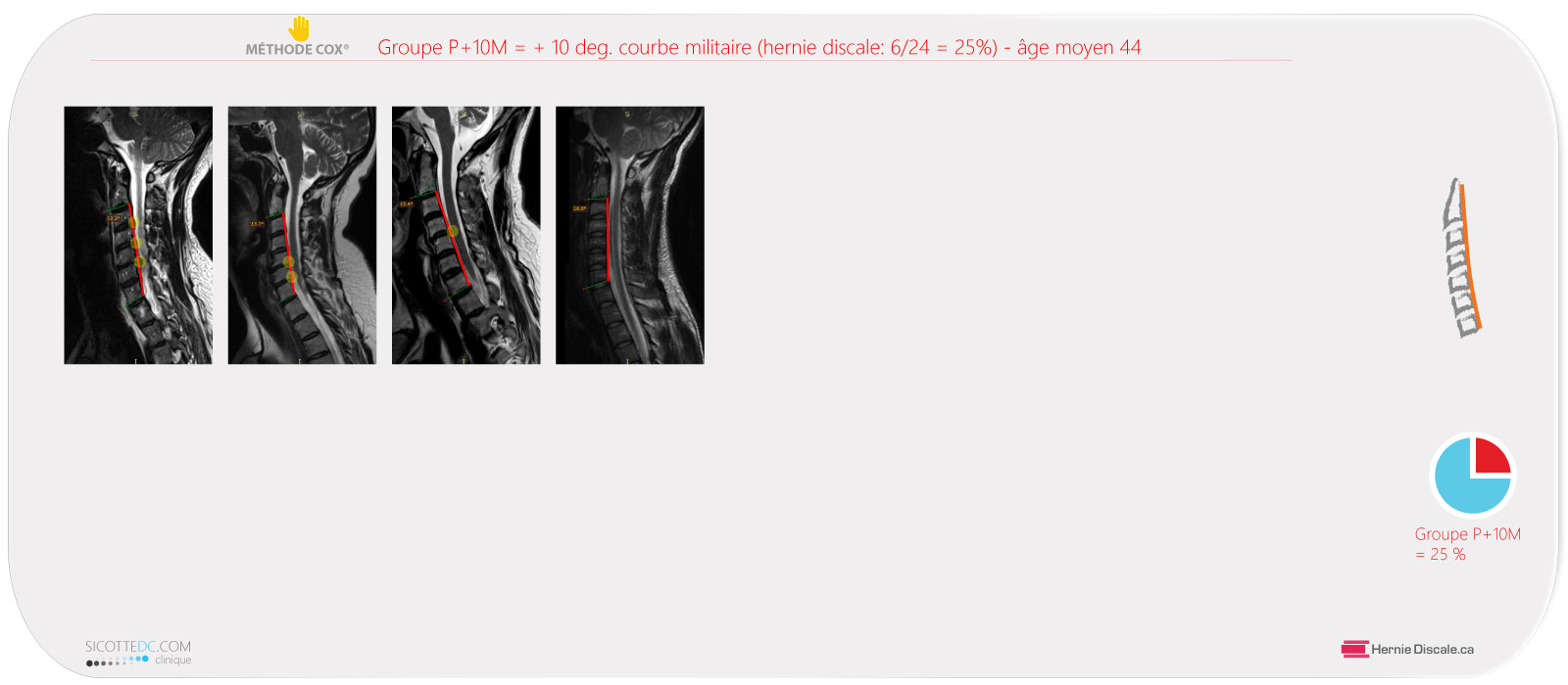 Comparaison IRM hernie discale #2