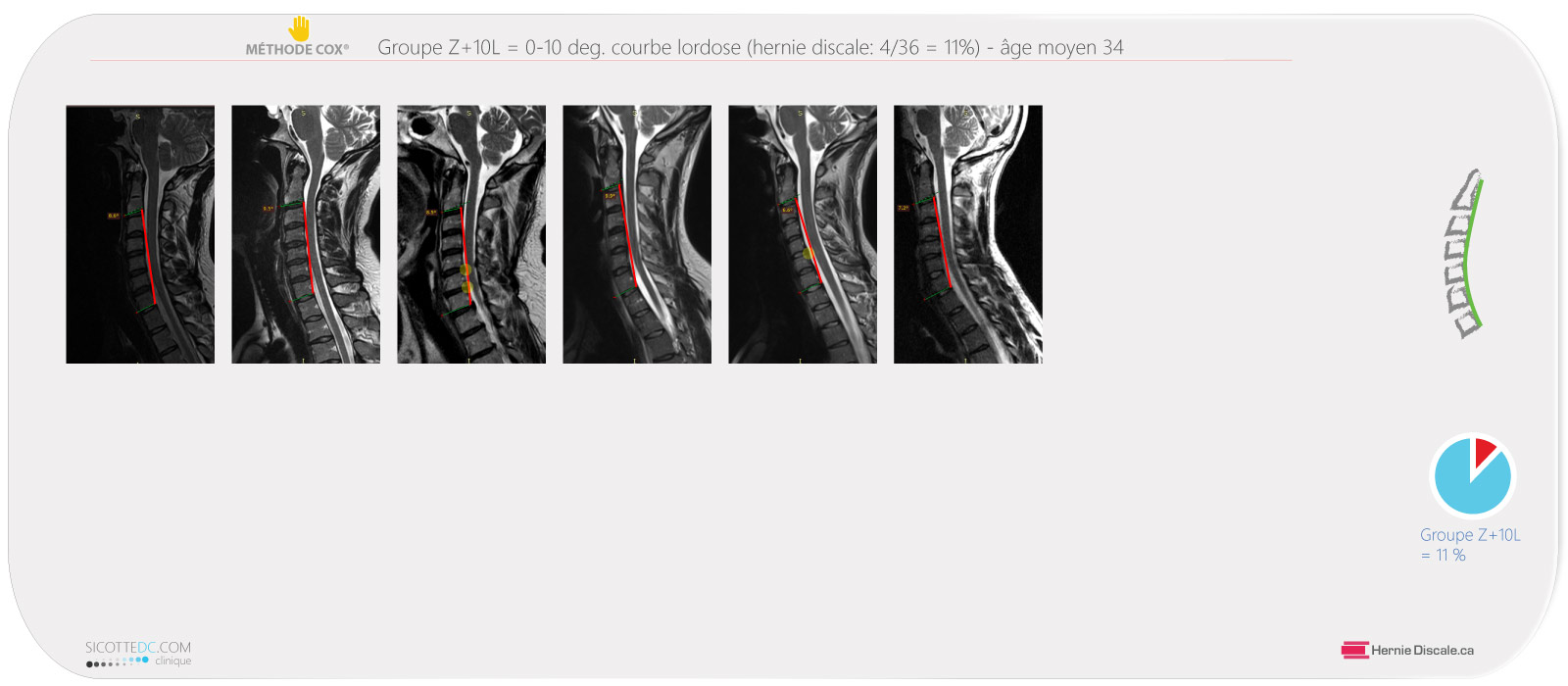 Comparaison IRM hernie discale #3