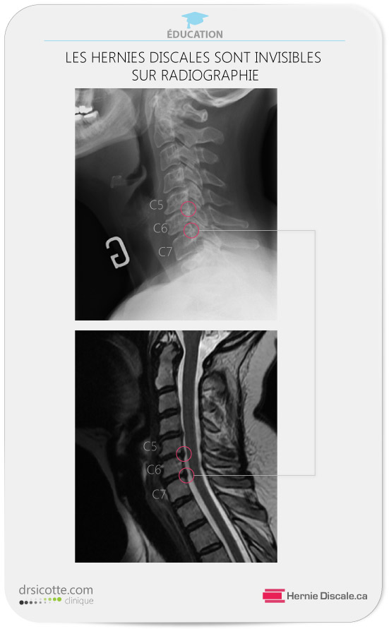 Sténose spinale cervicale | Symptômes | C4-C5-C6-C7 |