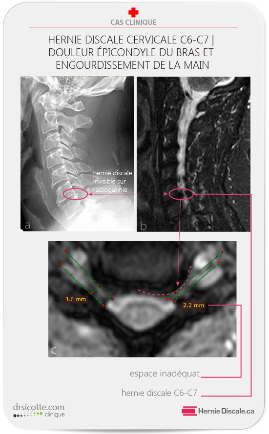Hernie discale cervicale C6-C7, stenose du foramen droite, comparaison avec radiographie. Symptôme épicondyle lattérale.