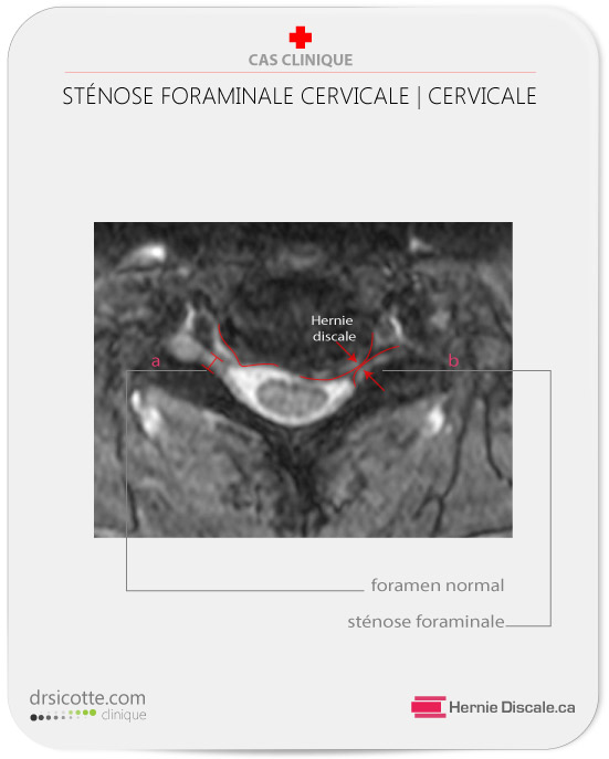 Sténose foraminale cervicale gauche avec ostéophytose  et hypertrophie facettaire.
