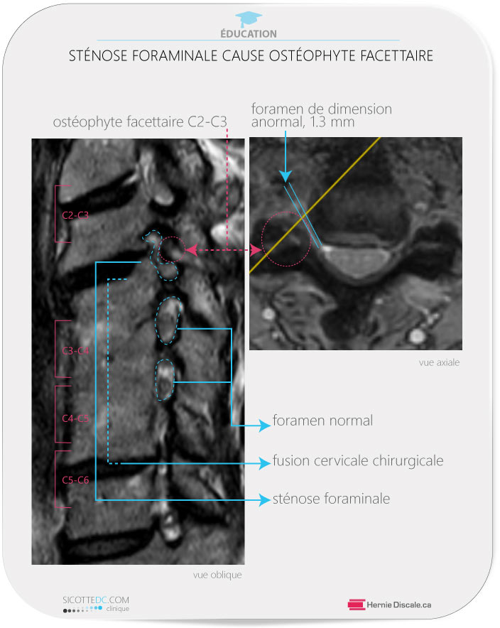 Sténose foraminale cervicale gauche C2-C3 avec ostéophytose et hypertrophie facettaire. Fusion chirurgicale cervicale.