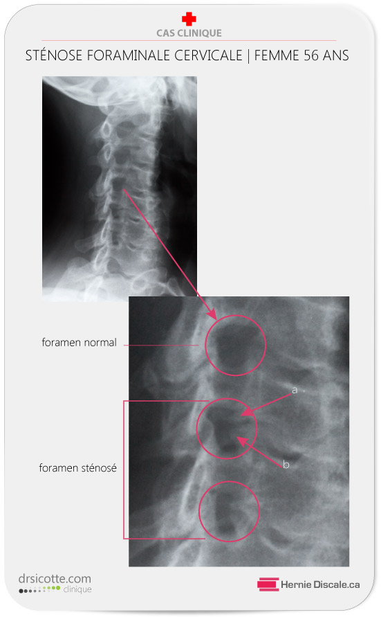 Sténose foraminale comparaison deux niveaux C5-C6-C7 radiographie