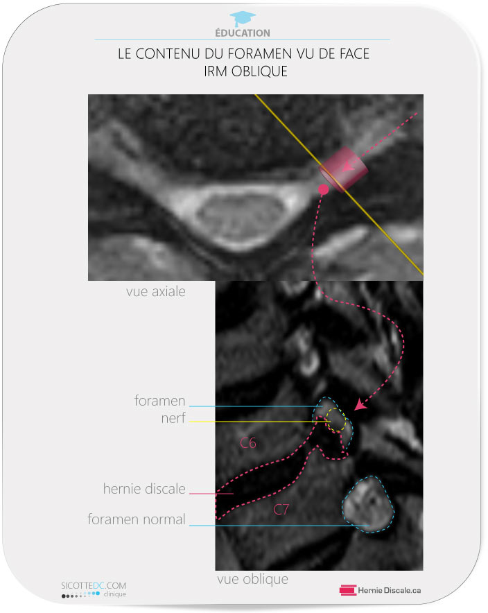 Vue de la sténose foraminale cervicale IRM oblique. Cervicale C6-C7