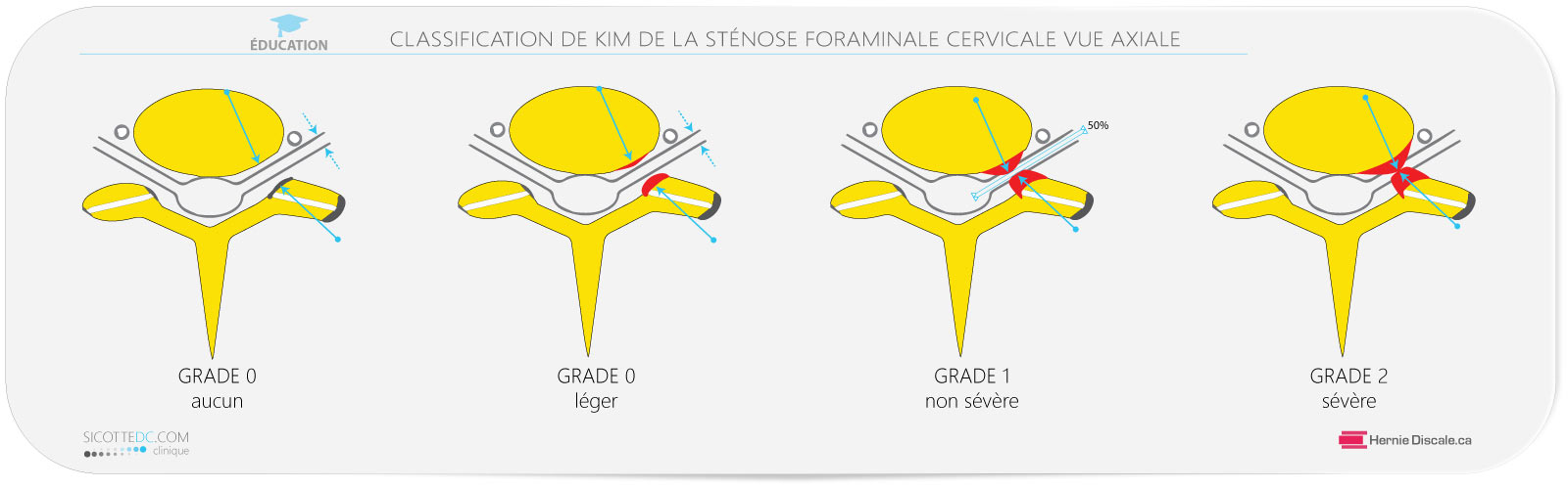 La classification de la sténose foraminale cervicale vue axiale IRM.