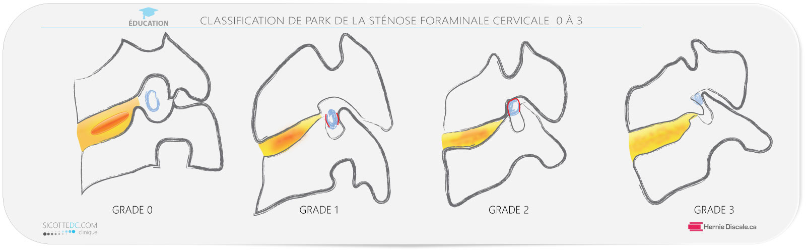 La classification de Park de la sténose foraminale cervicale. IRM