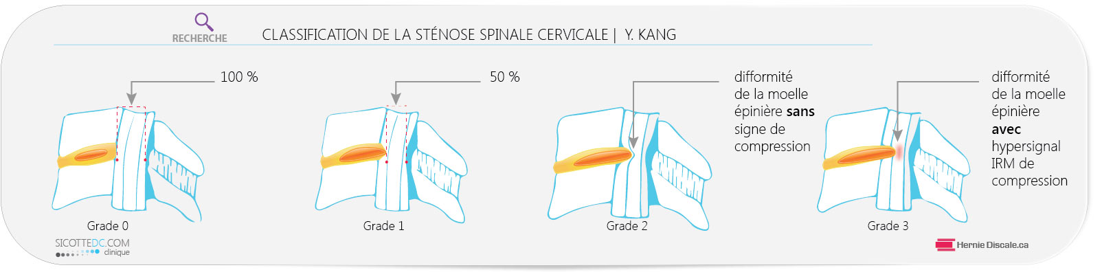 La classification de la sténose spinale cervicale Y Kang.