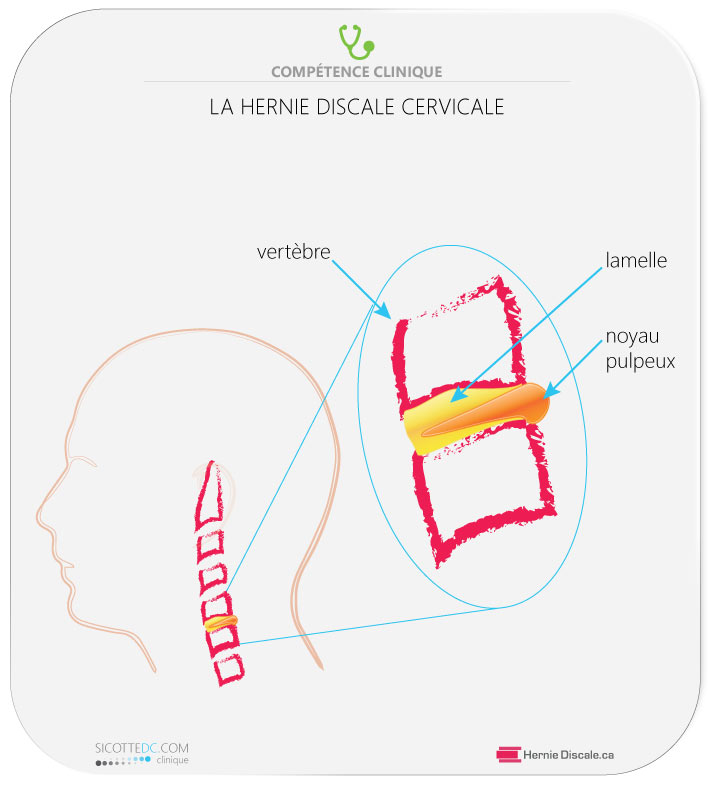 La hernie discale cervicale C6-C7, traitement naturel.