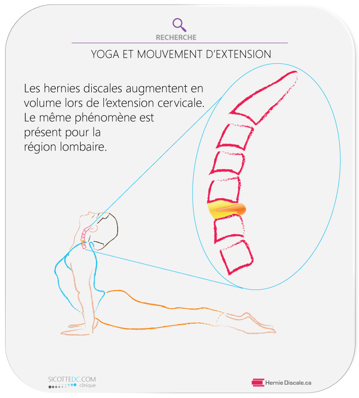 La salutation au soleil (yoga) diminue l'espace foraminale et augmente la hernie discale cervicale.