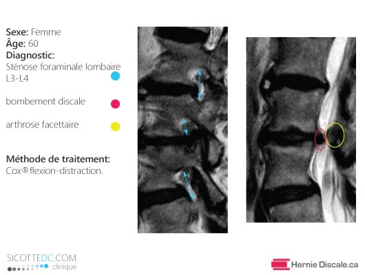 Remerciement patient de 60 ans avec sténose spinal lombaire et hernie discale lombaire. Traitement méthode Cox.