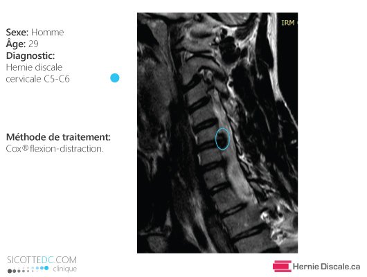 Remerciement patient avec hernie discale cervicale C5-C6. Traitement méthode Cox.