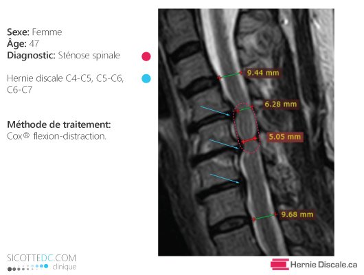 Remerciement patiente de 47 ans avec sténose spinal cervicale et symptôme de myélopathie. Traitement méthode Cox.