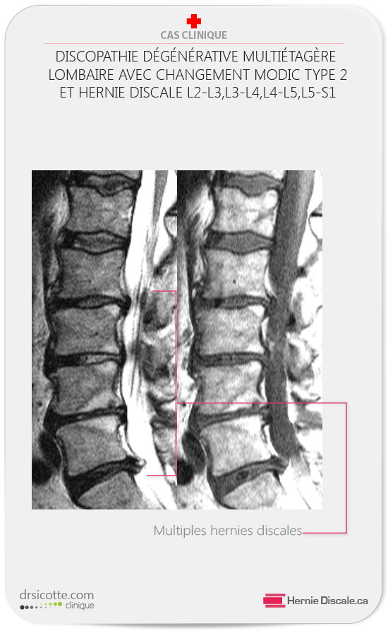 Multiple hernie discale : La discarthrose cause de multiples hernies discales L2-L3,L3-L4,L4-L5,L5-S1.