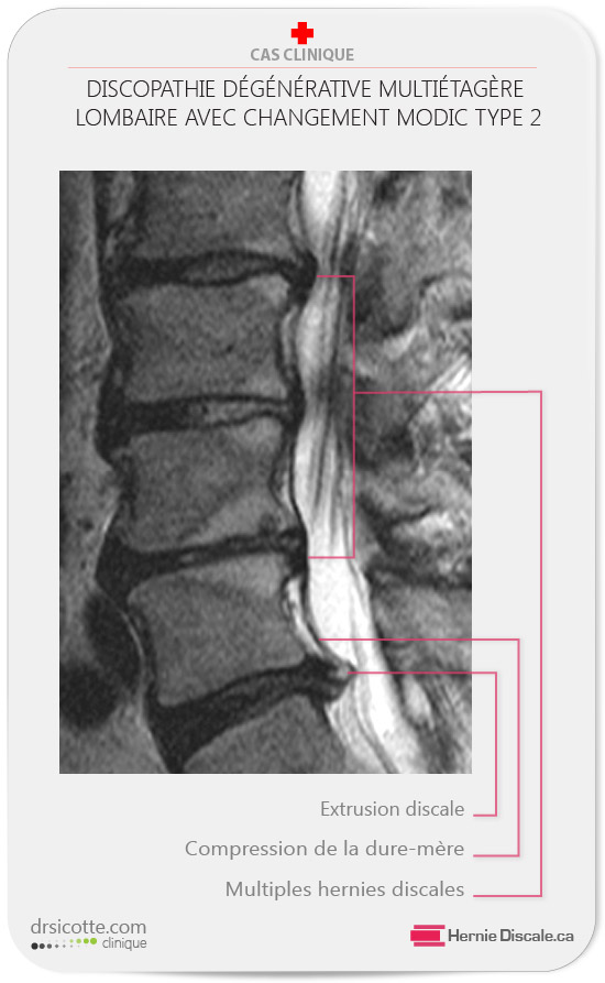 Multiple hernie discale extrusion L5-S1. Hypertrophy du ligament jaune. Discarthrose lombaire avec changement Modic.
