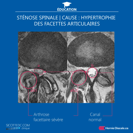 hypertrophie de du ligament jaune cause de la sténose spinale lombaire.