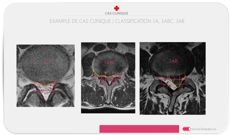 IRM de trois cas exemple de la classification MSU, 1A, 1ABC et 3AB .