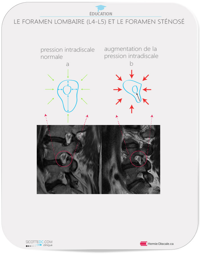 Comparaison du foramen lombaire sténosé et normale.