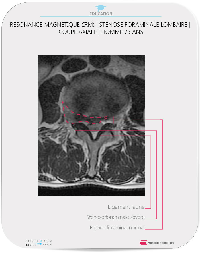 Sténose foraminale avec hernie discale à faisceau large L4-L5