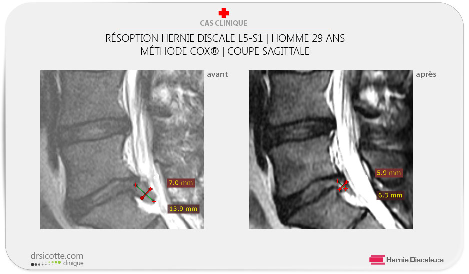 La résorption d'une extrusion hernie discale avant et aprês traitement méthode Cox.