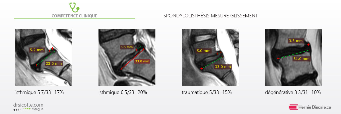 Quatre images imagerie par résonance magnétique IRM, spondylolisthésis isthmique, dégénératif et taumatique analyse de l'antériorité.