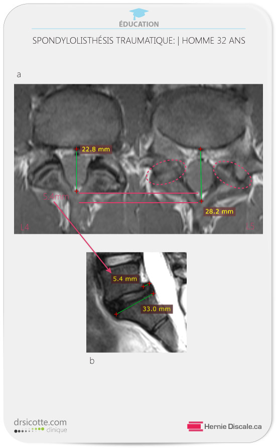 Imagerie par résonance magnétique spondylolisthésis L4-L5 traumatique vue axial.