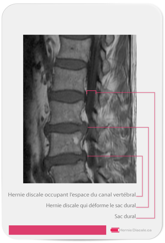 Multiple hernie discale avec sténose foraminale sévère L3-L4 L4-L5. Vue sagittale.