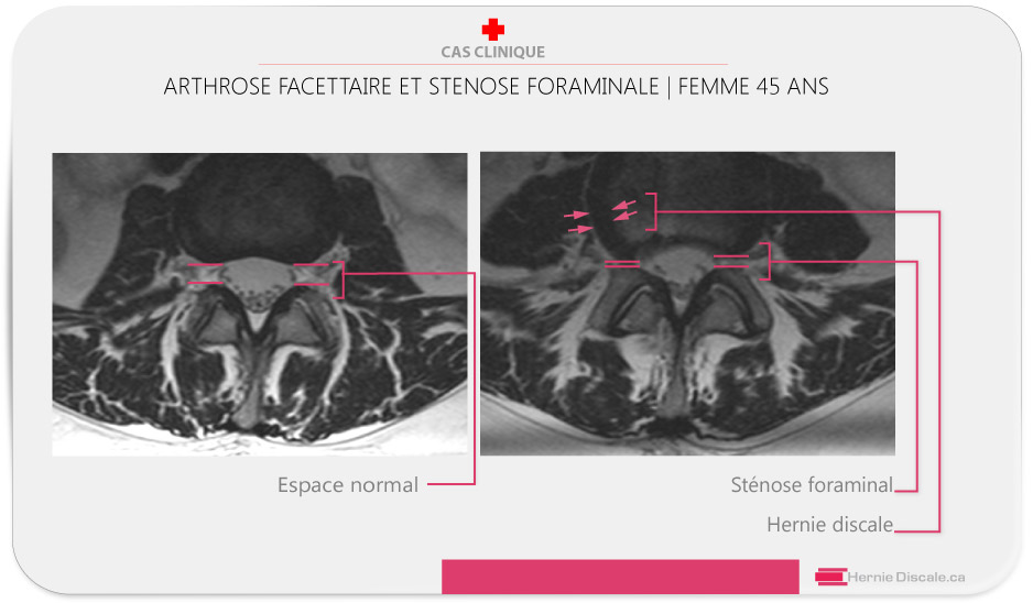 IRM axial avec arthrose facettaire et stenose foraminale. Le récessus latérale lombaire.