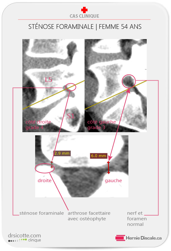 CT scan d'une stenose foraminale sévère cause discopathie dégénérative L5-S1.