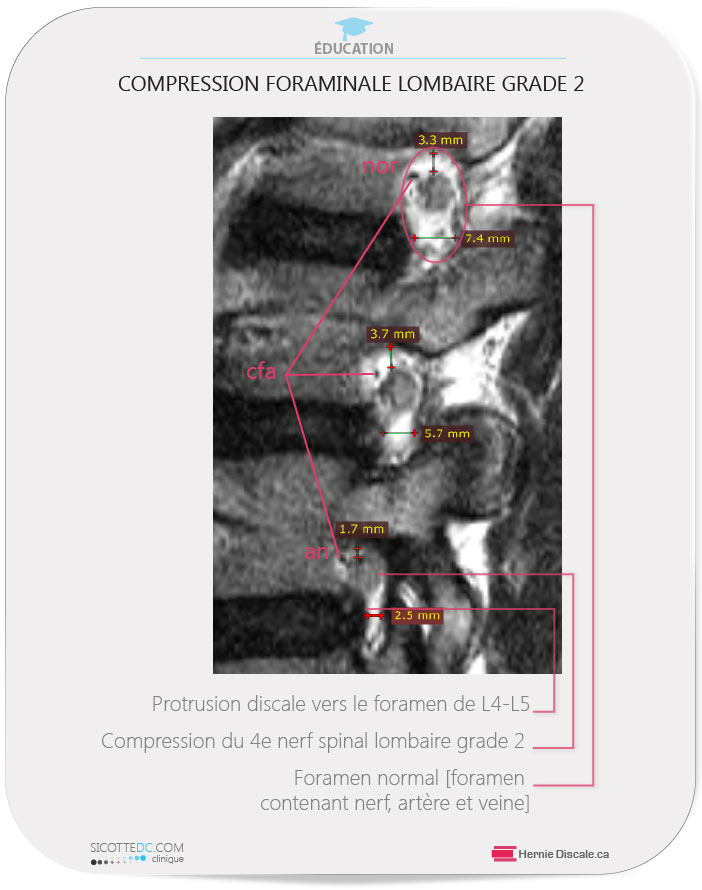 IRM parasagittale du foramen lombaire. Comparaison sténosé et normal.