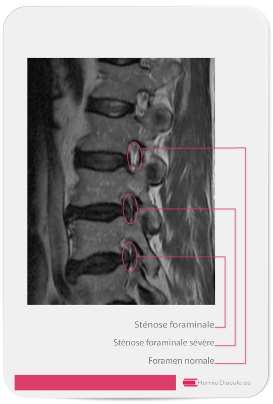 Vue para-sagittale du foramen intervertébrale avec sténose foraminale sévère L3-L4 L4-L5
