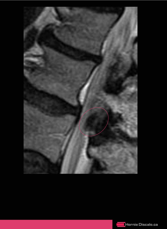 Coupe sagittale d'un segment vertébrale lombaire avec hypertrophie du ligament jaune qui cause une sténose spinale. 
