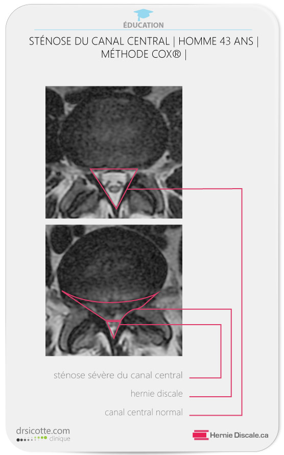 Coup axial d'une hernie discale lombaire a faisceau large causant une sténose spinale sévère.