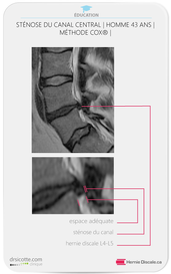 Coup sagittale d'une hernie discale lombaire causant une sténose spinale sévère avec hypertrophie du ligament jaune..