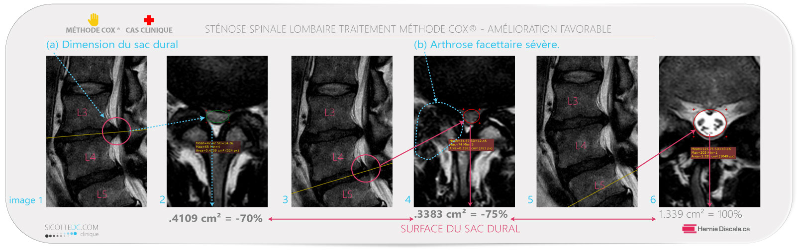 Sténose spinale lombaire L3-L4 et L4-L5 avec dimension du sac thecal. Marche a pied sans douleur. Méthode Cox®.