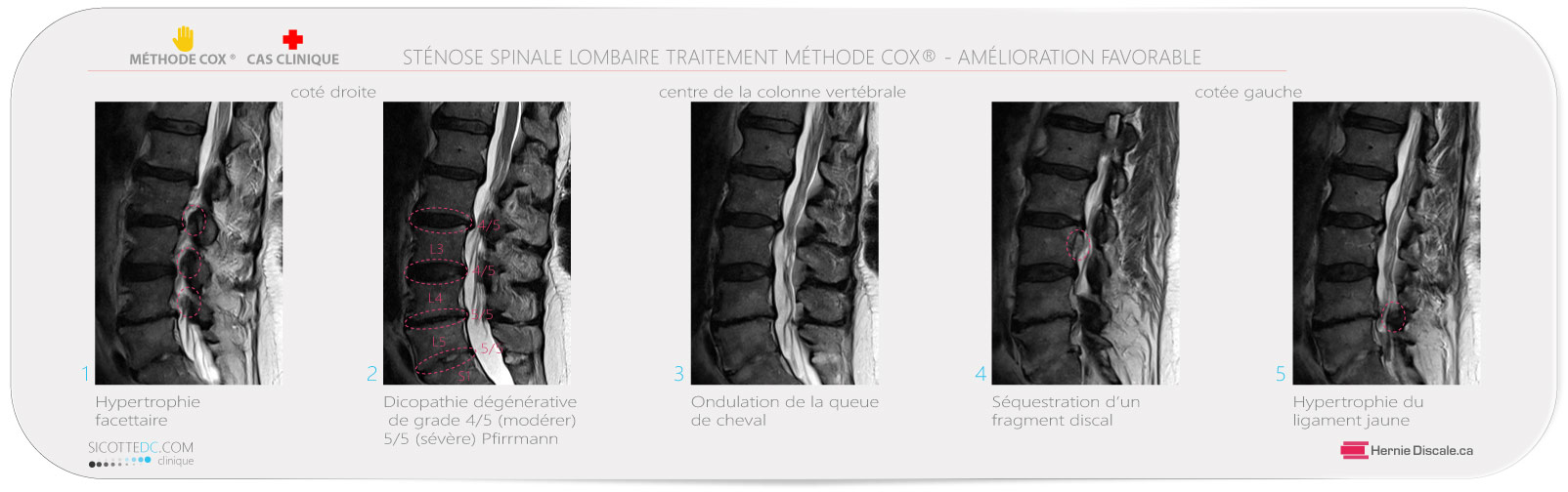 Sténose spinale lombaire femme de 72 ans. Resultats des traitement méthode Cox.