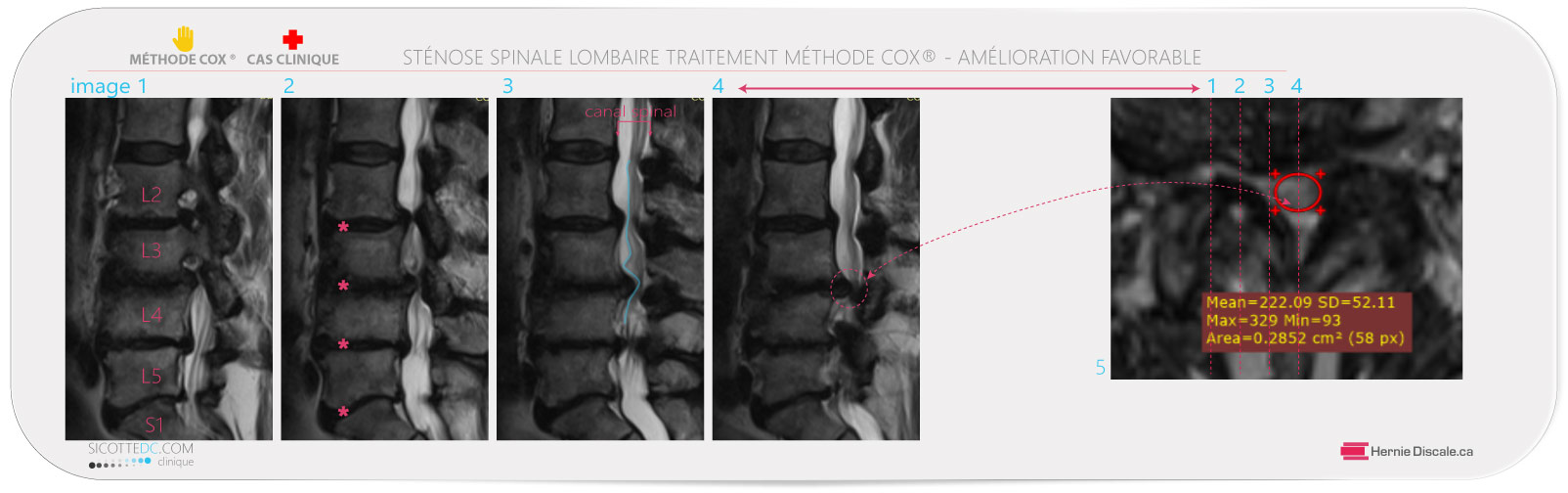 Sténose spinale femme 82 ans. On retrouve une compression sévère aux segments L3-L4.