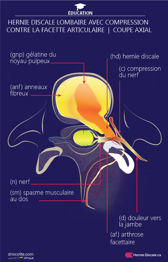 Explication du méchanisme de l'arthrose lombaire facettaire avec hernie discale.