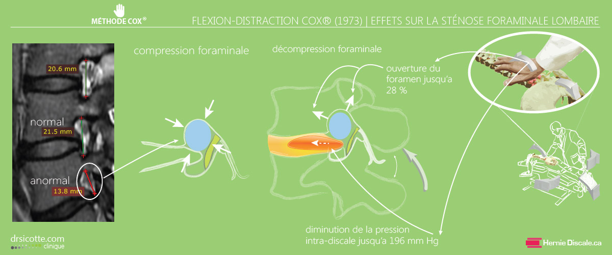 La flexion disctraction de la méthode Cox sur la pression intradiscale et foraminale lombaire. 