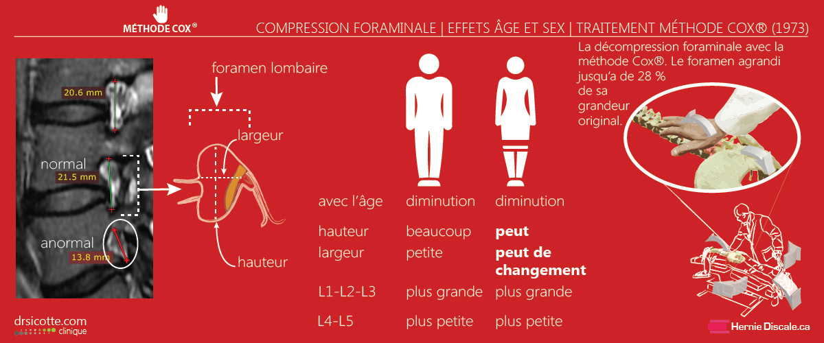 La compression foraminale. Effets de l'âge et le sexe. Méthode de traitement Cox.