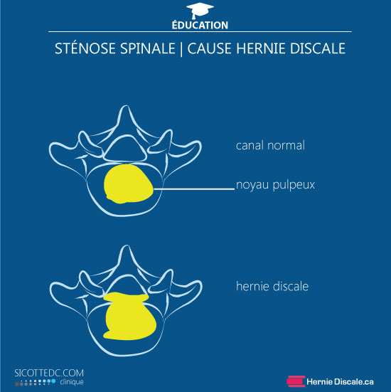 Discarthrose lombaire du corps vertébrale cause de la sténose spinale lombaire.