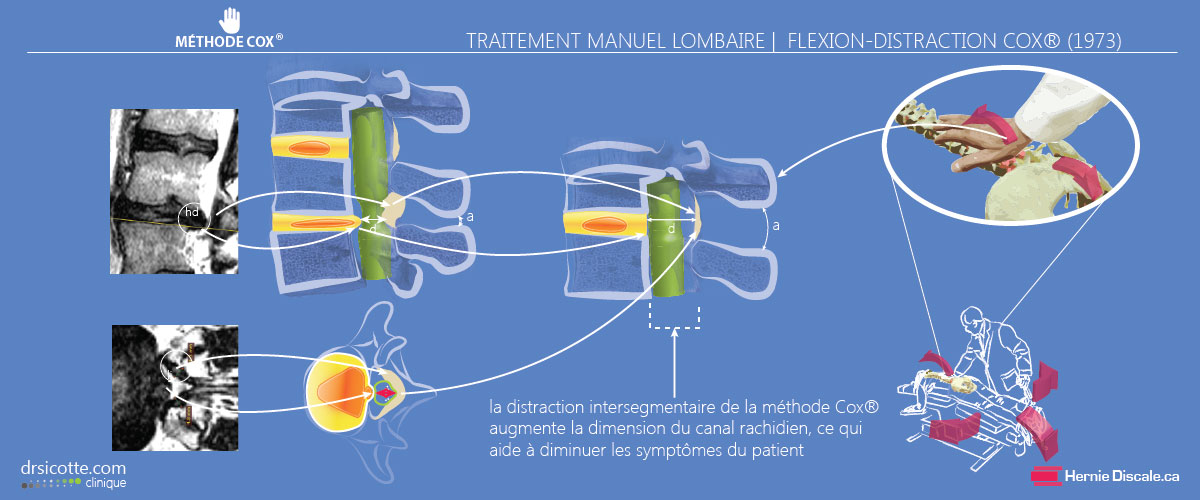Démonstration d'un traitement pour sténose spinale avec la méthode Cox®.
