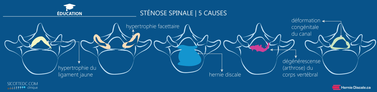 Cinq cause de la sténose spinale.